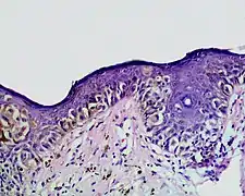 Kettenartig aneinandergereihte atypische Melanozyten