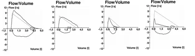 Typische Fluss-Volumen-Diagramme bei (v. l. n. r.) normaler Atmung, fehlender Mitarbeit des Patienten, Asthma, und COPD