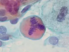 Tripolare Mitose in einem Ausstrichpräparat (Bronchiallavage)