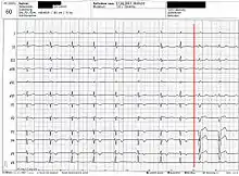 unauffälliges Ruhe-EKG mit einsetzendem Linksschenkelblock
