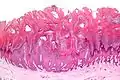 Viruswarze, histologisch