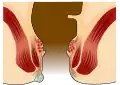 Grafische Darstellung einer Perianalthrombose