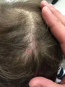 Der Kopf eines Kindes, zwischen den Haaren erkennt man einen kleinen, runden, geröteten Hautdefekt.