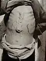 Von Schistosomiase Betroffener (China)