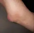Bursitis olecrani, entstanden nach einem Sturz auf den Ellbogen