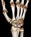 Carpal boss in der Computertomographie: VR-3D-Rekonstruktion. Pseudarthrotische Verbindung der Knochenvorsprünge am Os metacarpale 3 und am Os trapezoideum.
