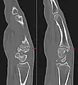Carpal boss in der Computertomographie: 2 nebeneinander liegende Schichten einer sagittalen MPR.