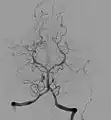 Subtraktionsangiographische Darstellung der vertebrobasilären Hirngefäße