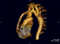 Aortenisthmusstenose – Rekonstruktion 3D
