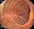 Blick vom Colon ascendens in das Zökum, die Bauhinsche Klappe ist am rechten Bildrand zu sehen