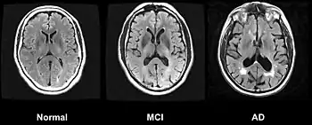 Drei Magnetresonanztomographie-Schnittbilder. Von links nach rechts mit Normal, MCI und AD beschriftet. Das linke Bild zeigt keine alzheimer-typischen Veränderungen, das mittlere mittelgradige Veränderungen, das rechte starke Veränderungen.