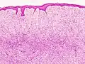 Rezidiv eines Dermatofibrosarcom protuberans HE-Färbung.