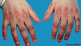 Gottron-Papeln der Fingergelenke