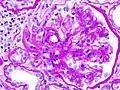 diabetische Nephropathie
