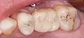 Eingesetzte verschraubte Implantatkrone in Regio 26 (Aufsicht)