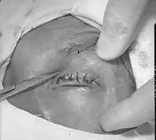 Operation bei Trachom