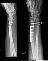 Gleiche Fraktur nach osteosynthetischer Versorgung. Das DRUG ist mit zwei kräftigen Kirschnerdrähten fixiert (Pfeile)