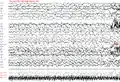 Generalisierter Spike-Wave-Komplex über 20 Sekunden