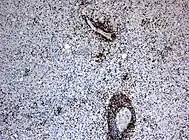 Nachweis dichter T-lymphozytärer entzündlicher Infiltrate (braun gefärbt) in der immunhistochemischen Färbung für CD3. Chromogen Diaminobenzidin, Gegenfärbung mit Hämatoxylin. Vergrößerung 200x.