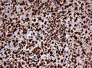 Nachweis zahlreicher Makrophagen (braun gefärbt) in der immunhistochemischen Färbung für CD68. Chromogen Diaminobenzidin, Gegenfärbung mit Hämatoxylin. Vergrößerung 200x.