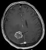 Hirnmetastase eines Bronchialkarzinoms in der Kernspintomographie (T1-Wichtung nach Kontrastmittelgabe)
