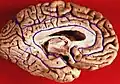 Ansicht von medial (Gyrus parahippocampalis mit „5“ gekennzeichnet)