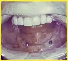 2 Implantate im Unterkiefer mit Patrizen zur Befestigung einer Cover-Denture-Prothese