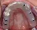Implantat-Bohrschablone intraoral bei Implantation (Aufsicht)