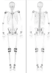 Skelettszintigrafien bei zwei Kindern, links 7 Jahre, rechts 15 Jahre alt (nicht maßstabsgerecht). Jeweils intensiver Knochenstoffwechsel in den Wachstumsfugen.
