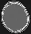 Im Vergleich dazu eine Computertomografie osteolytischer Metastasen in den Schädelknochen einer Patientin mit Mammakarzinom. Zu sehen ist eine größere Osteolyse frontal und mehrere kleinere.