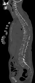 Sagittal rekonstruierte CT, Darstellung im Knochenfenster. Da die Patientin multiple Metastasen in allen Körperregionen hatte, konnte sie die Arme nicht für die Untersuchung nach oben nehmen, weshalb die Hände mit abgebildet sind.
