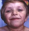 5-jähriges Kind mit LEOPARD-Syndrom, cafè-au-lait-Flecken und Dysmorphie-Zeichen: Hypertelorismus, Ptosis, blaue Skleren, niedriger Ansatz von dysmorphen Ohren