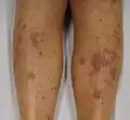 Lichen planus beider Beine