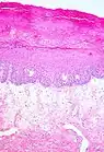 Histologie eines hypertrophen Lichen sclerosus.