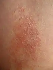 Lichen simplex chronicus am Unterarm