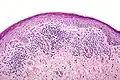 Lichen ruber planus mit weniger stark ausgeprägter Akanthose