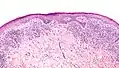 Lichen ruber planus mit weniger stark ausgeprägter Akanthose
