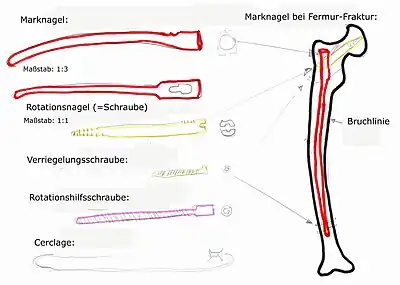 Marknagel im Oberschenkelknochen