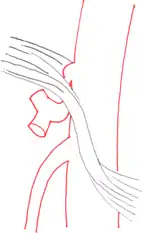 Schematische Darstellung: links der anatomische Normalbefund, das Ligamentum arcuatum medianum liegt oberhalb des Abganges der Arteria coeliaca; rechts gut zu erkennen, wie das Ligamentum das Gefäß einschnürt.