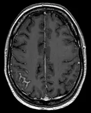 Bildgebung: Nachweis einer fokalen Meningeosis carcinomatosa bei Mammakarzinom in der Magnetresonanztomographie. Man erkennt die fokale Anreicherung (hell) in den Sulci als Zeichen einer arachnoidalen Ausbreitung rechts (links im Bild).