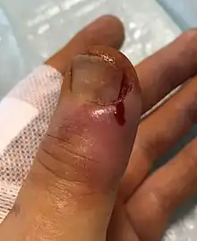 Inzision und Teilentfernung des Daumennagels nach Paronychie