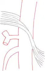 Schematische Darstellung: links der anatomische Normalbefund, das Ligamentum arcuatum medianum liegt oberhalb des Abganges der Arteria coeliaca; rechts gut zu erkennen, wie das Ligamentum das Gefäß einschnürt.