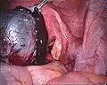 Eröffnete Endometriosezyste des linken Eierstocks