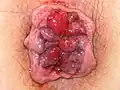 Hämorrhoiden 4° = Analprolaps