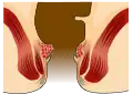 Hämorrhoiden ersten Grades