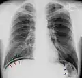 Pneumoperitoneum im Thoraxröntgenbild. Die freie "Luft" ist zwischen dem Oberrand der Leber (rote Pfeile) und dem Zwerchfell (grüne Pfeile) zu erkennen. Die blauen Pfeile zeigen auf den gasgefüllten Dickdarm (normal).