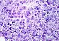 HE-Färbung (Eosinophiles Infiltrat gut erkennbar)