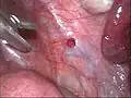Roter Endometrioseherd