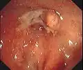 Endoskopische Aufnahme einer Analfistel