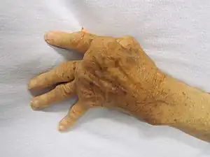 Typische Ulnardeviation bei rheumatoider Arthritis